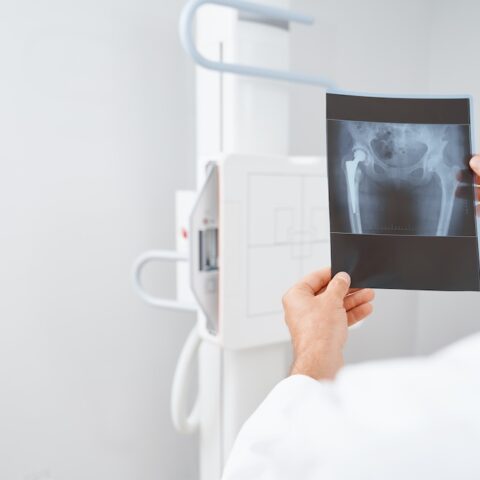 Doctor holding X-ray of patient's hip bone.